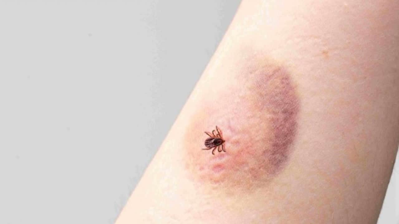 Foto - Kene ısırığı sonrası bu görüntü varsa dikkat