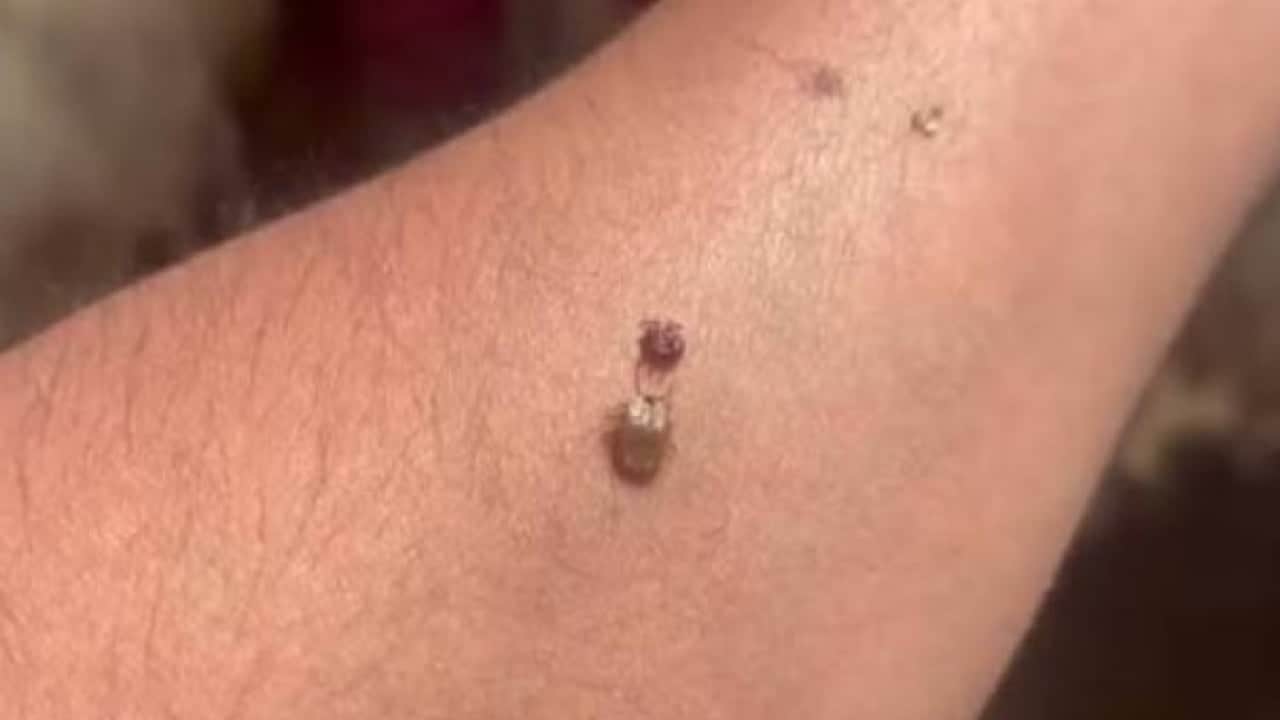 Foto - Kene ısırığı sonrası bu görüntü varsa dikkat