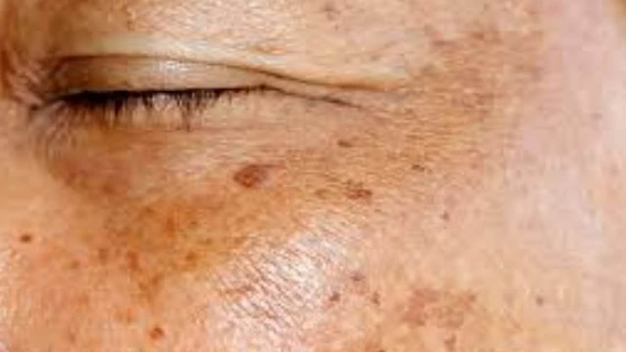 Foto - Limon kabuğunu çöpe atmak yerine yüzünüze sürün: Sürünce lekelerden eser kalmıyor! Yıllarca sürüldü, sınandı