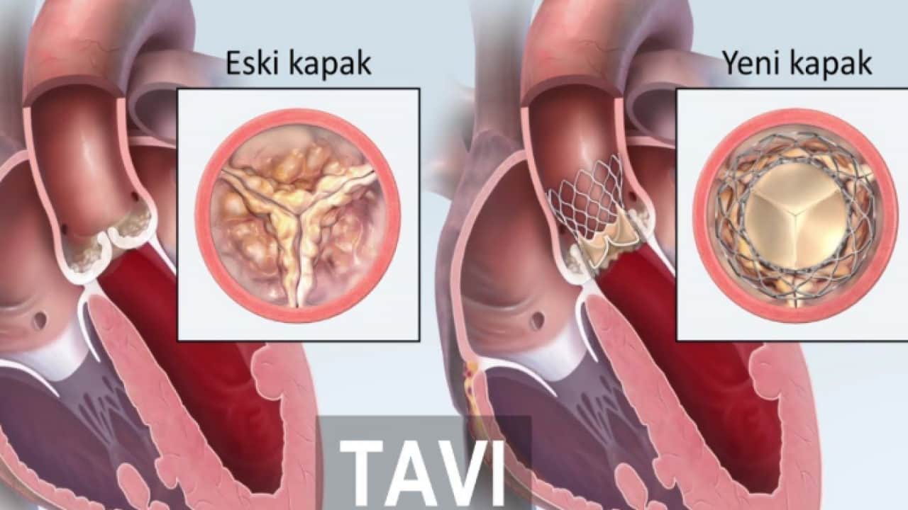 Foto - Ne neşter var ne cerrahi izi: Kalp kapağı hastaları 2 günde ayağa kalkıyor