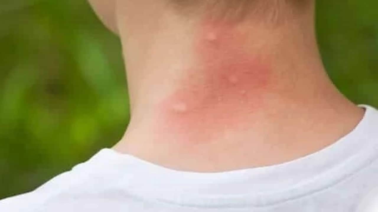 Foto - Sivrisineklerin bazı insanları daha çok ısırmasının nedeni ortaya çıktı