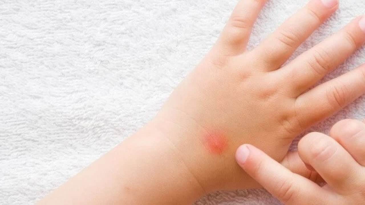 Foto - Sivrisineklerin bazı insanları daha çok ısırmasının nedeni ortaya çıktı