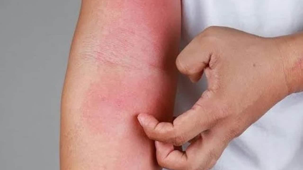Foto - Sivrisineklerin bazı insanları daha çok ısırmasının nedeni ortaya çıktı