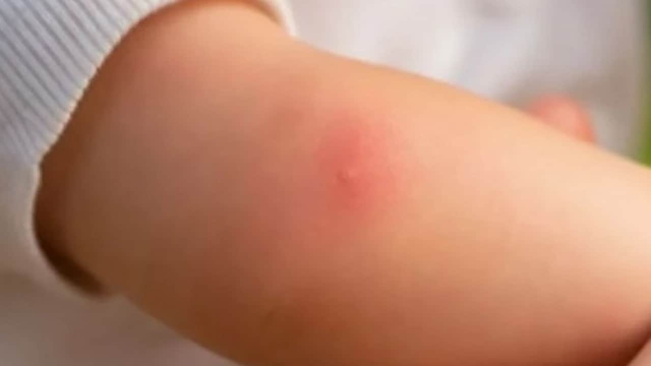 Foto - Sivrisineklerin bazı insanları daha çok ısırmasının nedeni ortaya çıktı