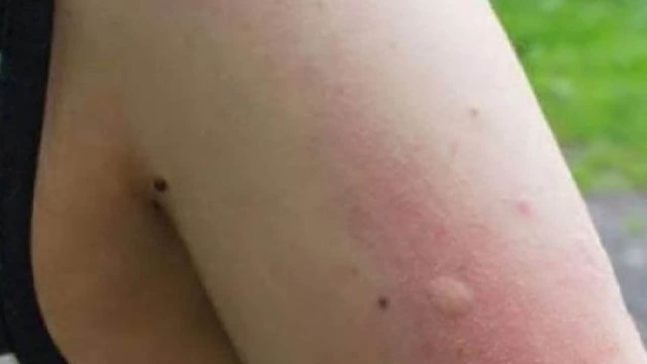 Foto - Sivrisineklerin bazı insanları daha çok ısırmasının nedeni ortaya çıktı