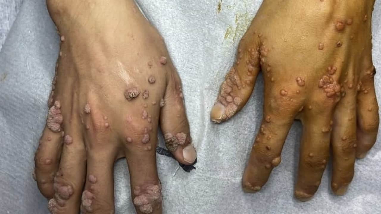 Foto - Suyunu sürmek yetiyor: Siğillere karşı daha etkili ilaç yok! Siğilleri düşürüyor... İbn-i Sina'nın gizli şifa reçetesi