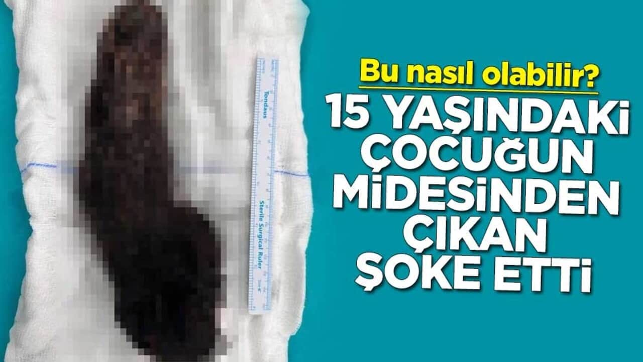 Bu nasıl olabilir? 15 yaşındaki çocuğun midesinden çıkan şoke etti