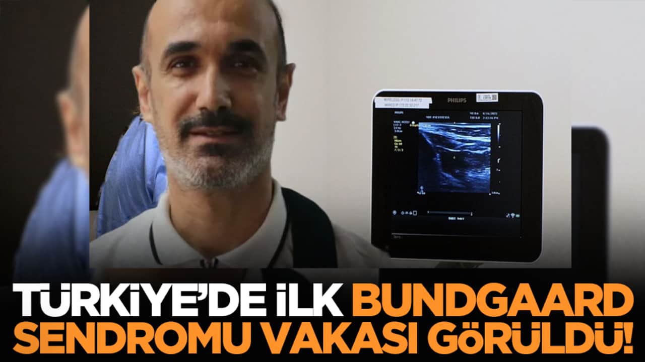 Türkiye’de ilk Bundgaard Sendromu vakası görüldü!