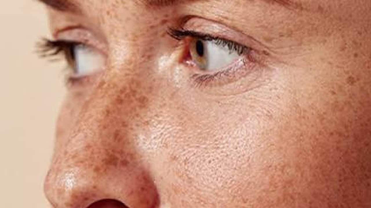 Güneş lekeleri nasıl çıkar? Doğal yöntem isteyen sürüyor Bu yöntemin amacı kurtulmak... Sorun yok oluyor