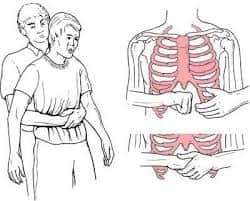 Heimlich manevrası nasıl uygulanır, hayat kurtarır mı?