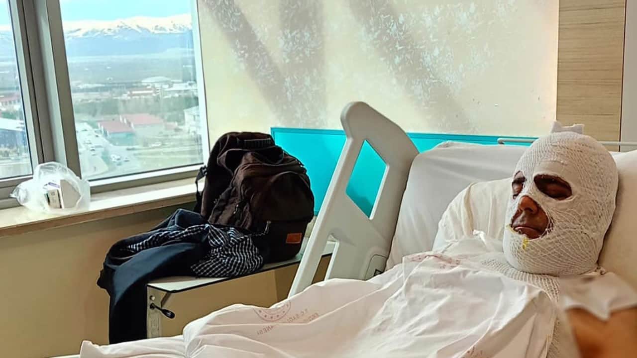Yüksek gerilim hattı hayatını kararttı! 42 gündür hastanede