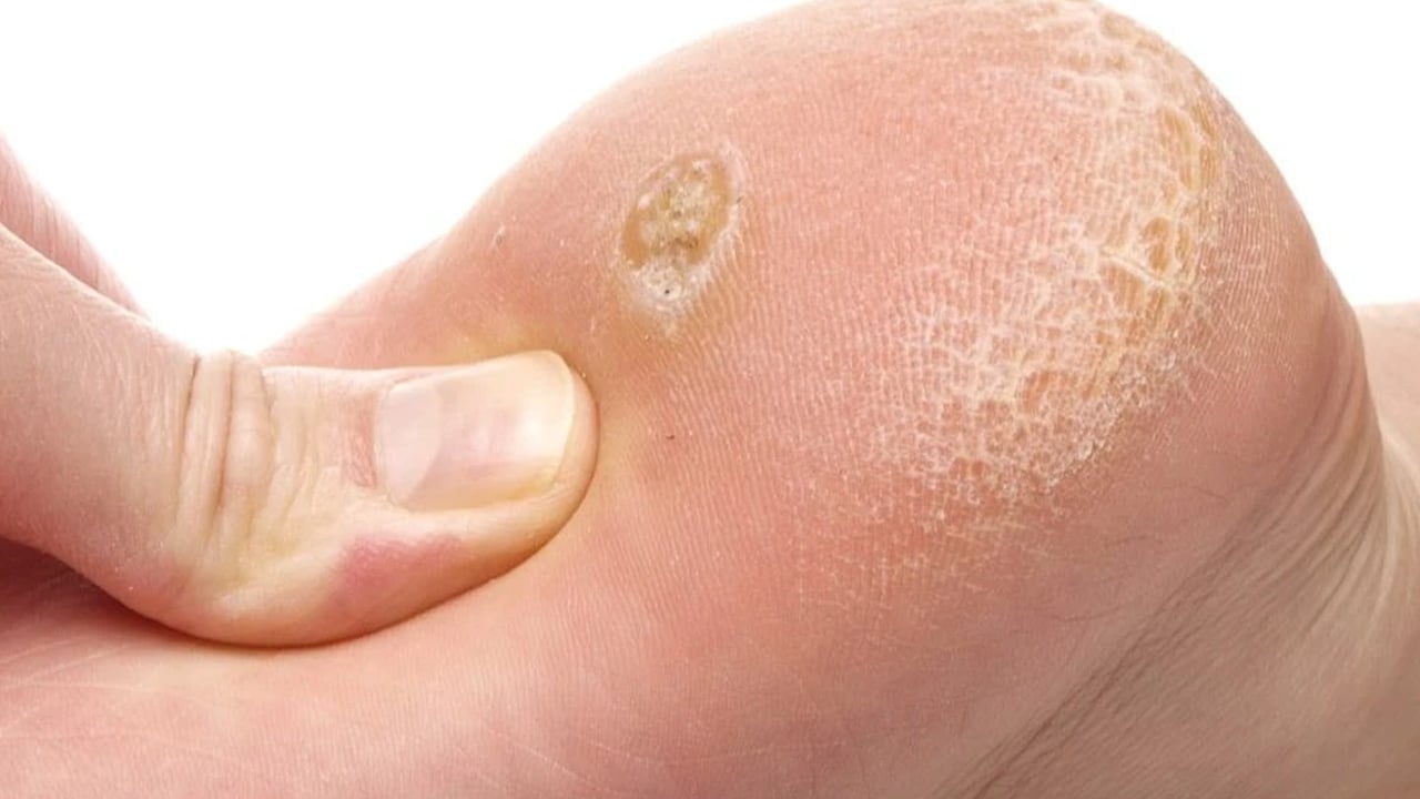 Foto - 1 damlası bile mantarın kökünü kurutuyor! Suda bekletin! Herkesi şaşırtan çare...