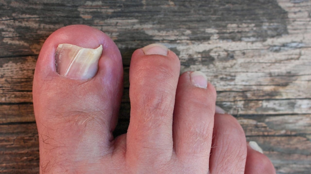 Foto - 1 damlası bile mantarın kökünü kurutuyor! Suda bekletin! Herkesi şaşırtan çare...