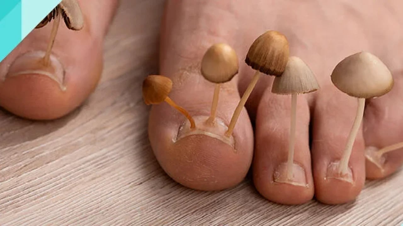 Foto - 1 damlası bile mantarın kökünü kurutuyor! Suda bekletin! Herkesi şaşırtan çare...