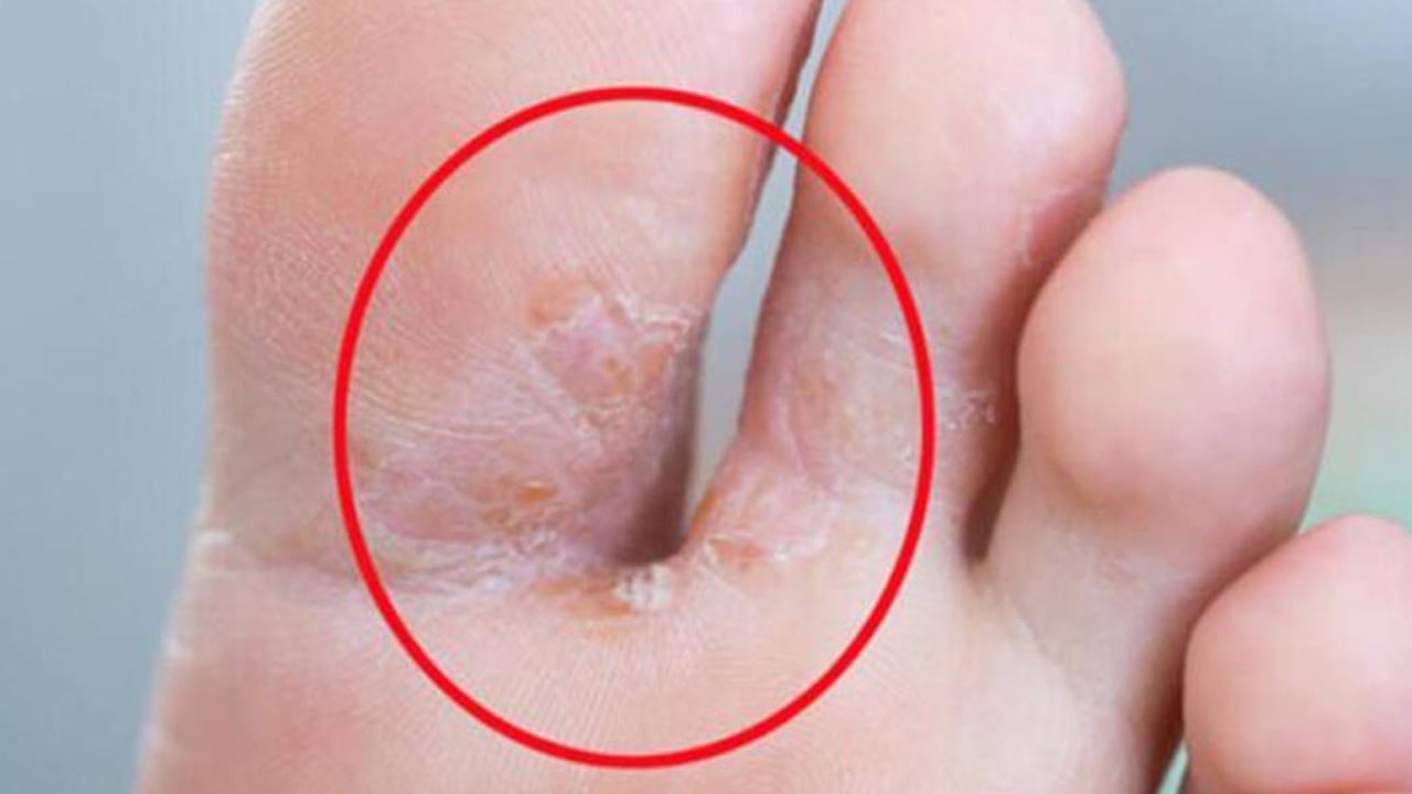 Foto - 1 damlası bile mantarın kökünü kurutuyor! Suda bekletin! Herkesi şaşırtan çare...