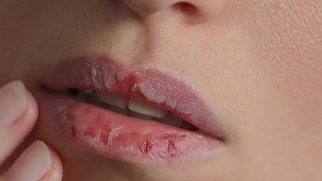 Foto - 1 gecede dudak kuruluğuna çözüm! Yapmayan tam manasıyla bin pişman: B1,B2 ve B3 sorunu olabilir