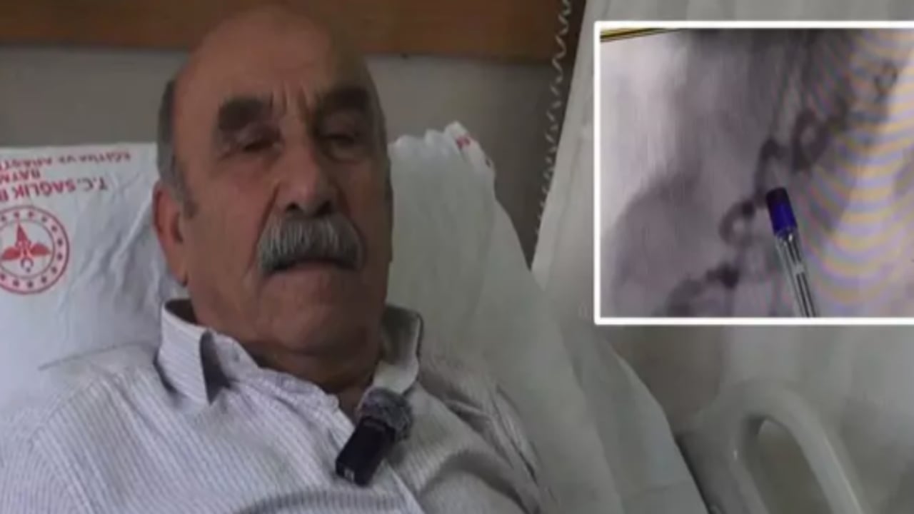 100 binde bir görülüyor! Göğüs yanması diye gitti, hayatının şokunu yaşadı