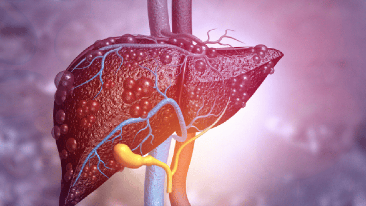 Foto - 2050 yılında yaklaşık 1.8 milyar kişi... Karaciğer yağlanması her 6 kişiden birini etkiliyor