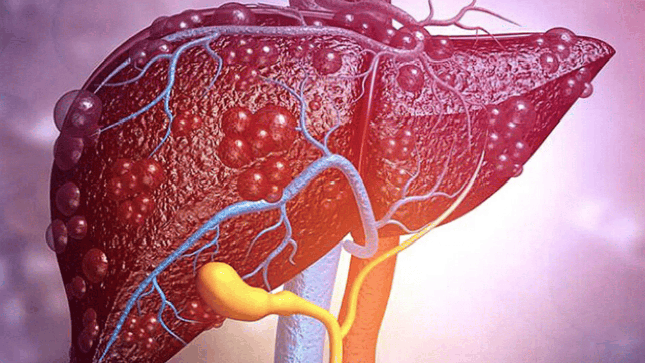 Foto - 2050 yılında yaklaşık 1.8 milyar kişi... Karaciğer yağlanması her 6 kişiden birini etkiliyor