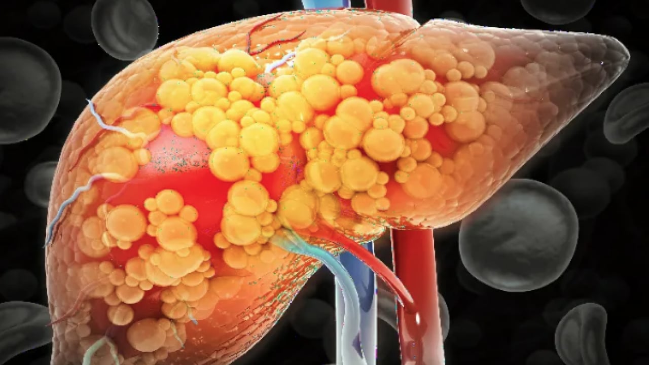 Foto - 2050 yılında yaklaşık 1.8 milyar kişi... Karaciğer yağlanması her 6 kişiden birini etkiliyor