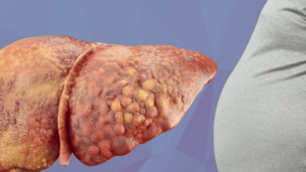 Foto - 2050 yılında yaklaşık 1.8 milyar kişi... Karaciğer yağlanması her 6 kişiden birini etkiliyor