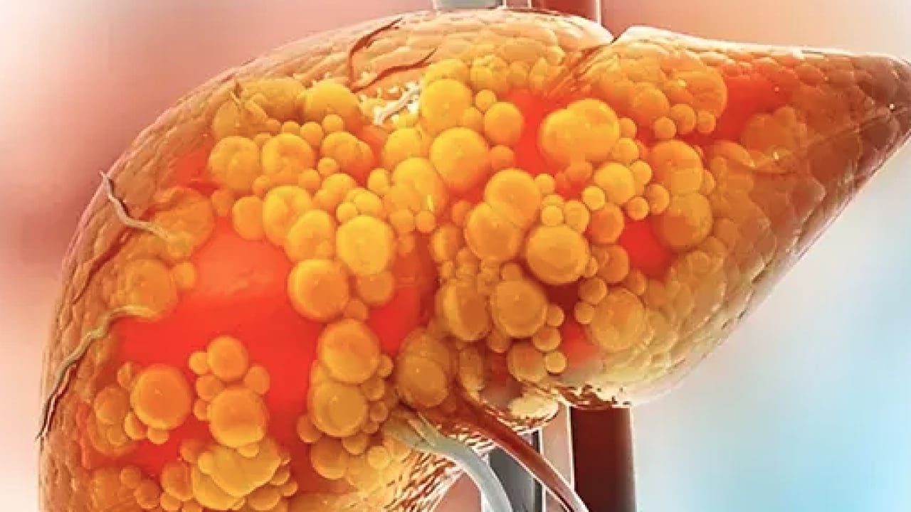 Foto - 2050 yılında yaklaşık 1.8 milyar kişi... Karaciğer yağlanması her 6 kişiden birini etkiliyor