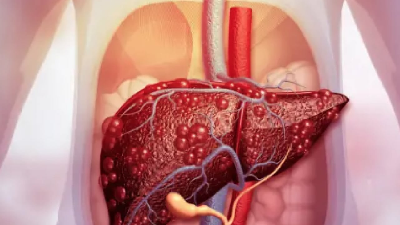 Foto - 2050 yılında yaklaşık 1.8 milyar kişi... Karaciğer yağlanması her 6 kişiden birini etkiliyor