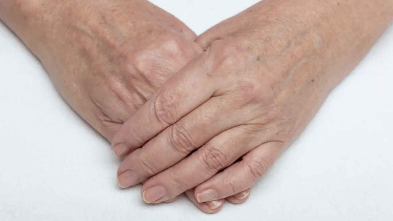 Foto - 25 yaşında 60 gibi görünüyor: İşte damarların belirgin olmasının 6 nedeni!