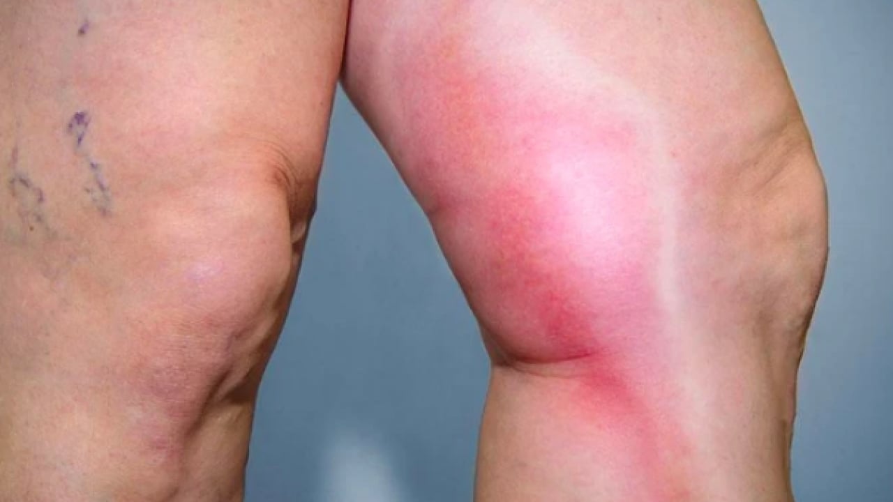 Foto - 25 yaşında 60 gibi görünüyor: İşte damarların belirgin olmasının 6 nedeni!