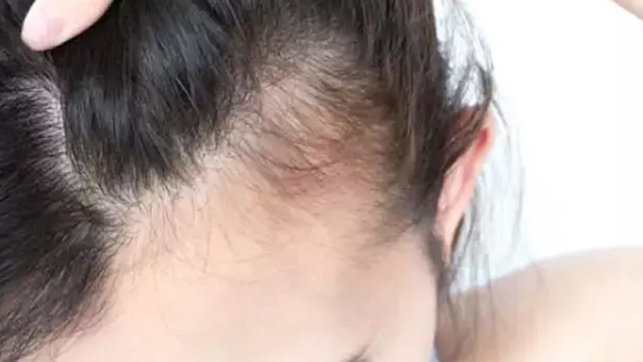 Foto - 3 malzemeyle saçlarınızı geri kazanın: Kabuğun değdiği yerden kalın saç fışkıracak! Saçlarına beyaz düşen tercih ediyor 