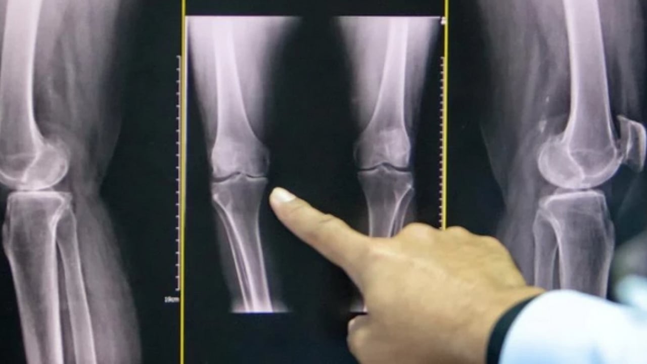 5 bilim insanı bakın ne yaptı! Kemik erimesi tedavisinde yapay zeka destekli ilaç projesi