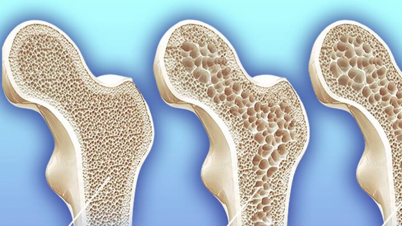 Foto - 5 bilim insanı bakın ne yaptı! Kemik erimesi tedavisinde yapay zeka destekli ilaç projesi