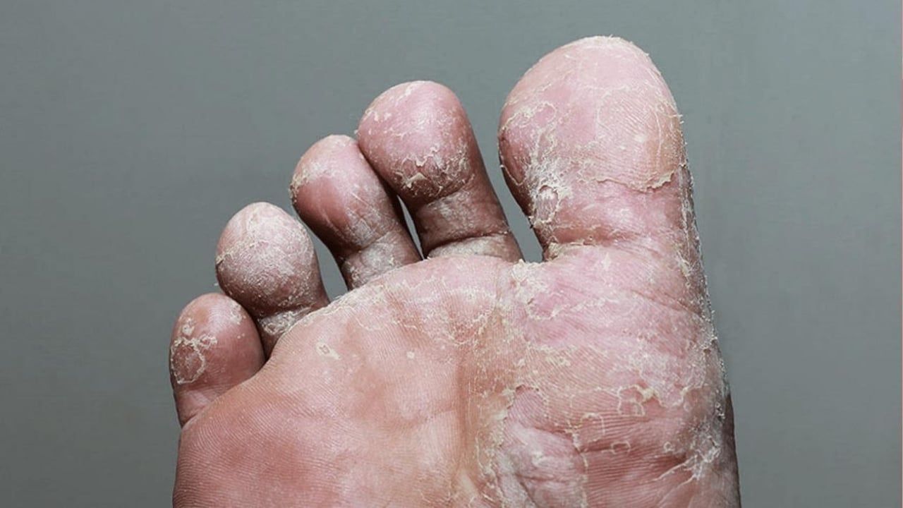 Foto - 5 dakikada ayaklarınız bebek gibi yumuşacık olacak! Bu yöntem, mantar ve egzamanın kökünü kurutuyor