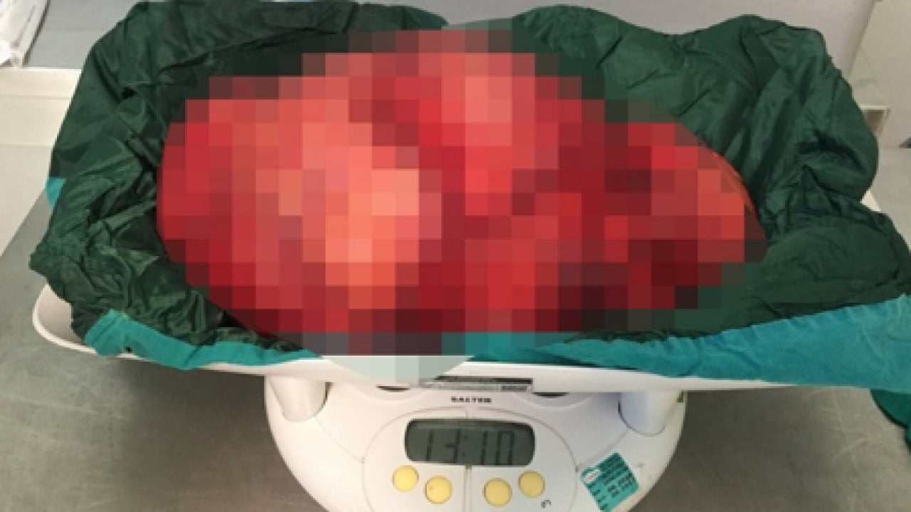 Foto - 77 yaşında 10 saatlik ameliyata girdi! Karaciğerinden 13 santimetre tümör çıkarıldı