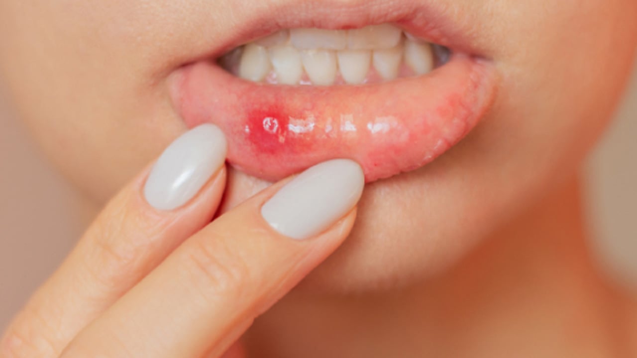 Foto - Ağız içi yaralarına ne iyi gelir? Önlemek için pek çok insan yararlanıyor! Bunu yapın, kararlılıkla önleyin 