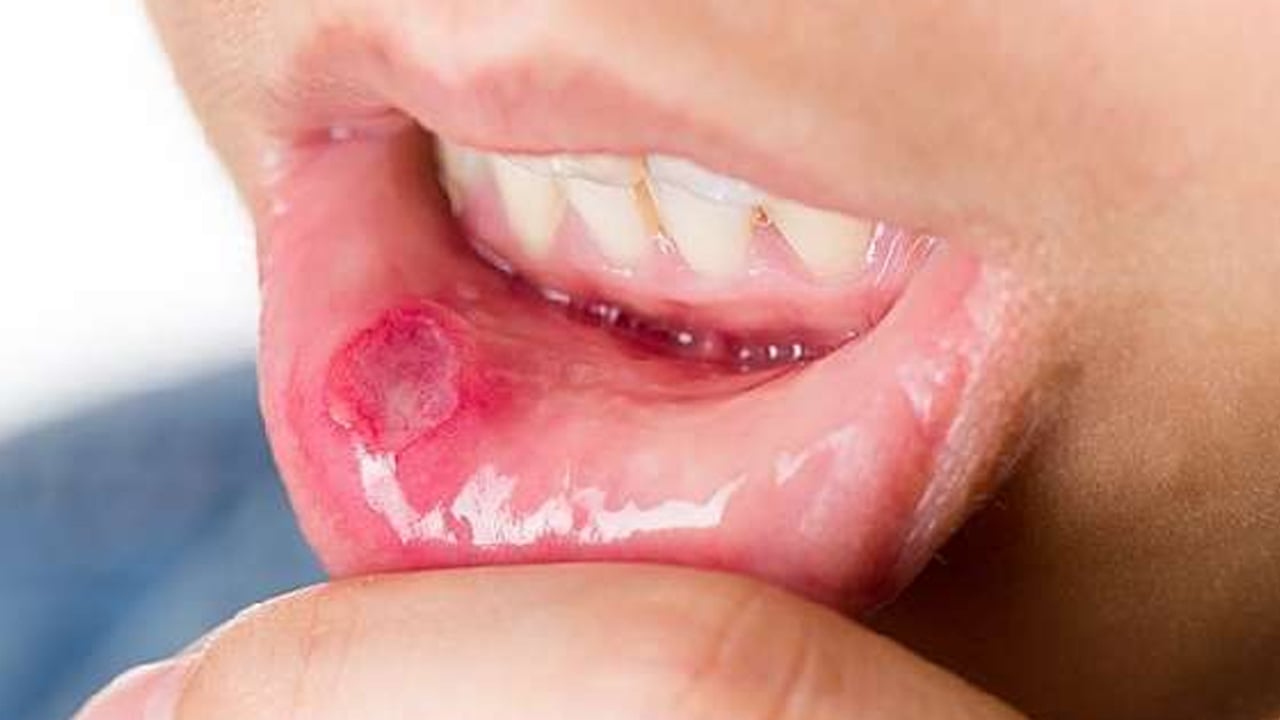 Ağız içi yaralarına ne iyi gelir? Önlemek için pek çok insan yararlanıyor! Bunu yapın, kararlılıkla önleyin 