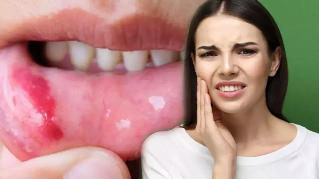 Foto - Ağız içi yaralarına ne iyi gelir? Önlemek için pek çok insan yararlanıyor! Bunu yapın, kararlılıkla önleyin 