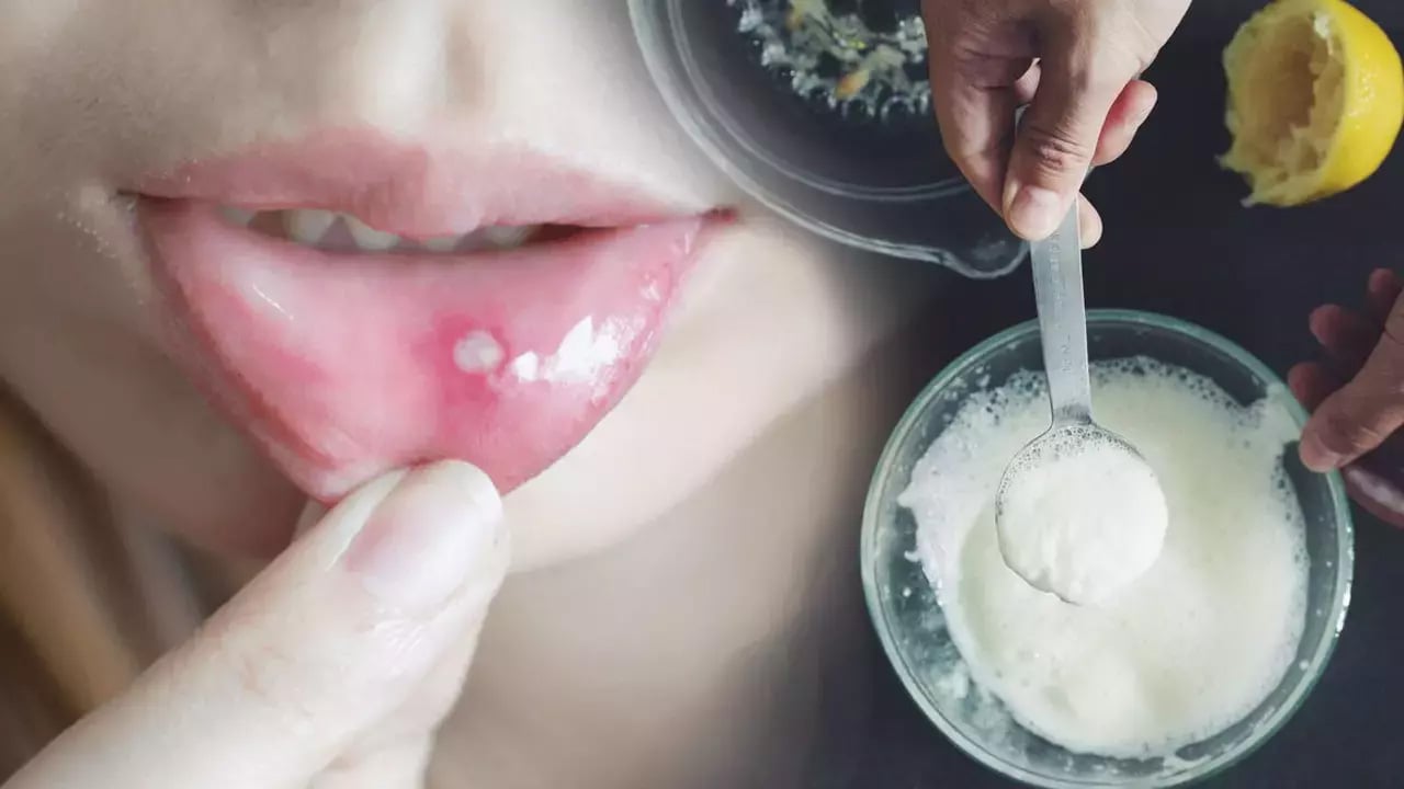 Foto - Ağız içi yaralarına ne iyi gelir? Önlemek için pek çok insan yararlanıyor! Bunu yapın, kararlılıkla önleyin 