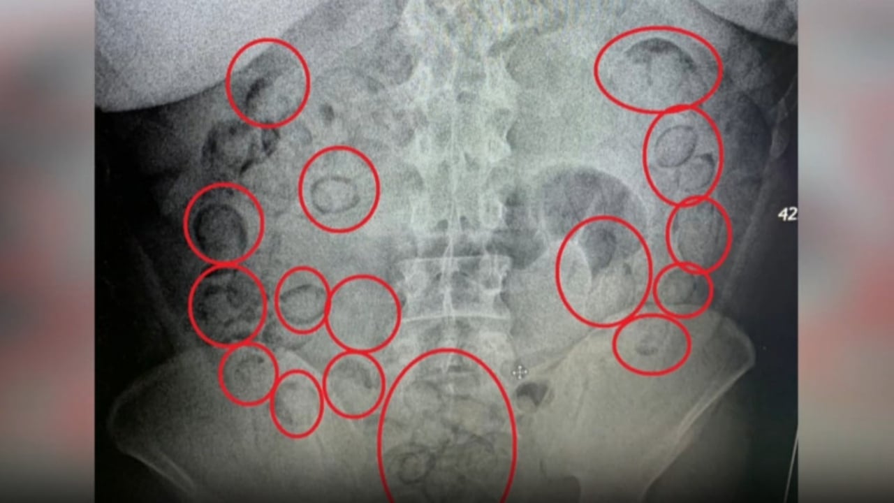 Ağızlar bir karış açık kaldı! Midesinden çıkanlar "yok artık" dedirtti