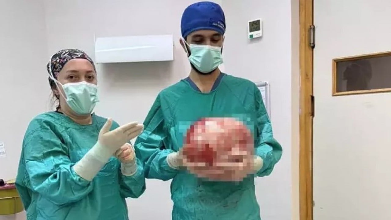Foto - "Ağrım var" diye hastaneye gitti! Karnından 8,5 kiloluk kitle çıktı