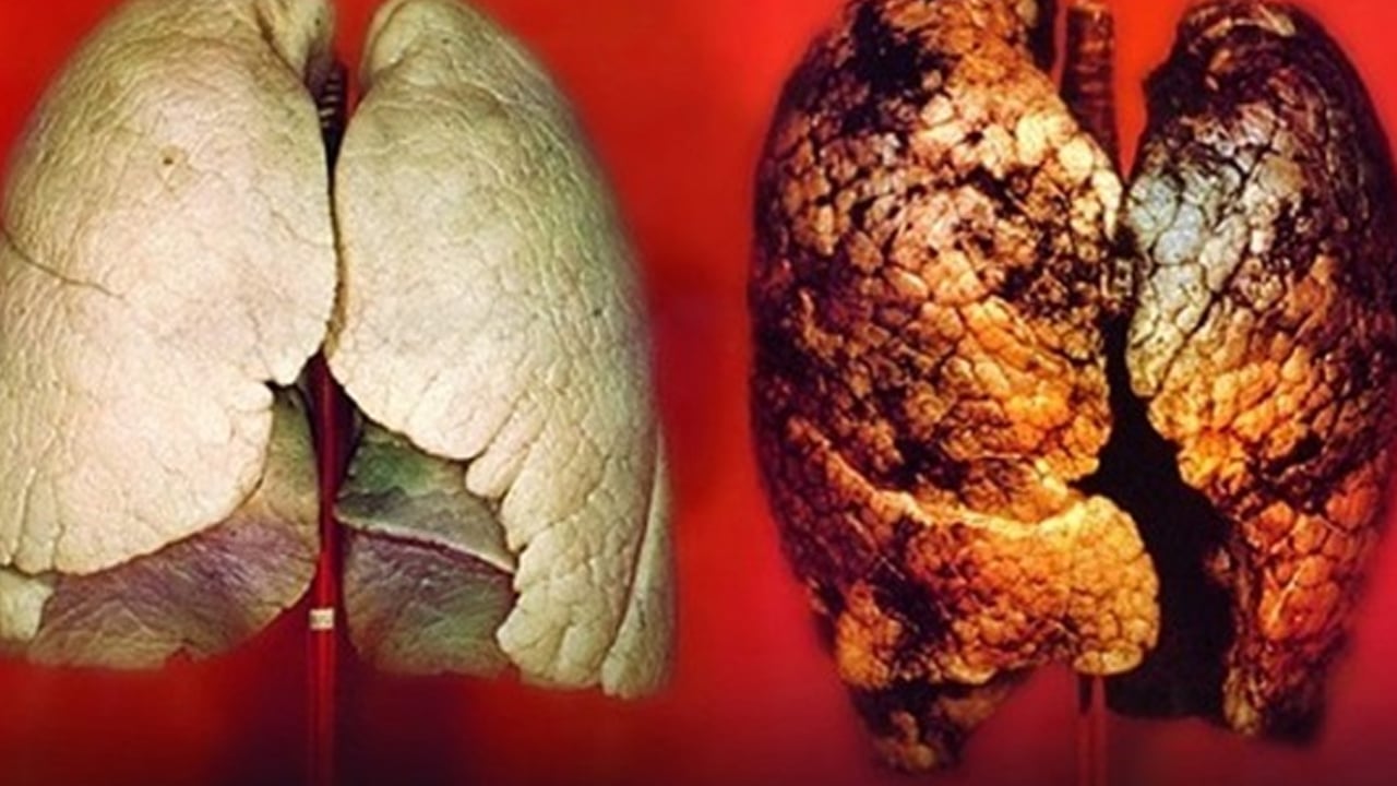 Foto - Akciğer kanseri belirtileri çok sinsi: Geçmeyen öksürük ve balgam uyarısı! Uzmandan tıbbi görüş ve öneri 