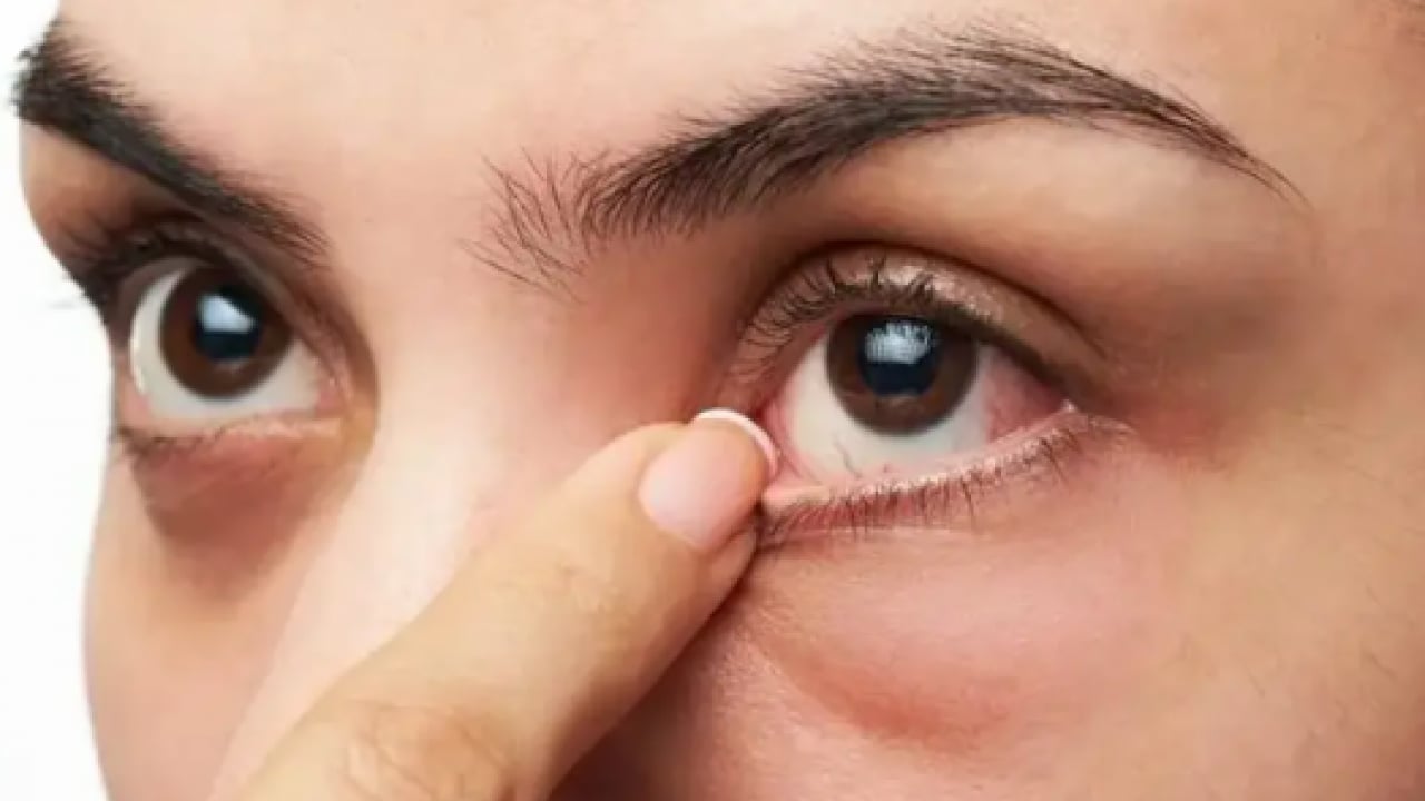 Foto - Altında başka nedenler olabilir! Sürekli gözünüz kaşınıyorsa dikkat