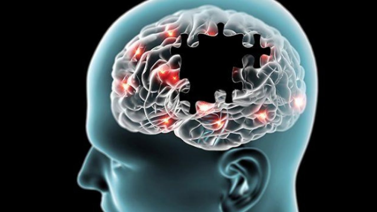 Foto - Alzheimer'la ilgili önemli detayı uzmanlar ortaya çıkardı!