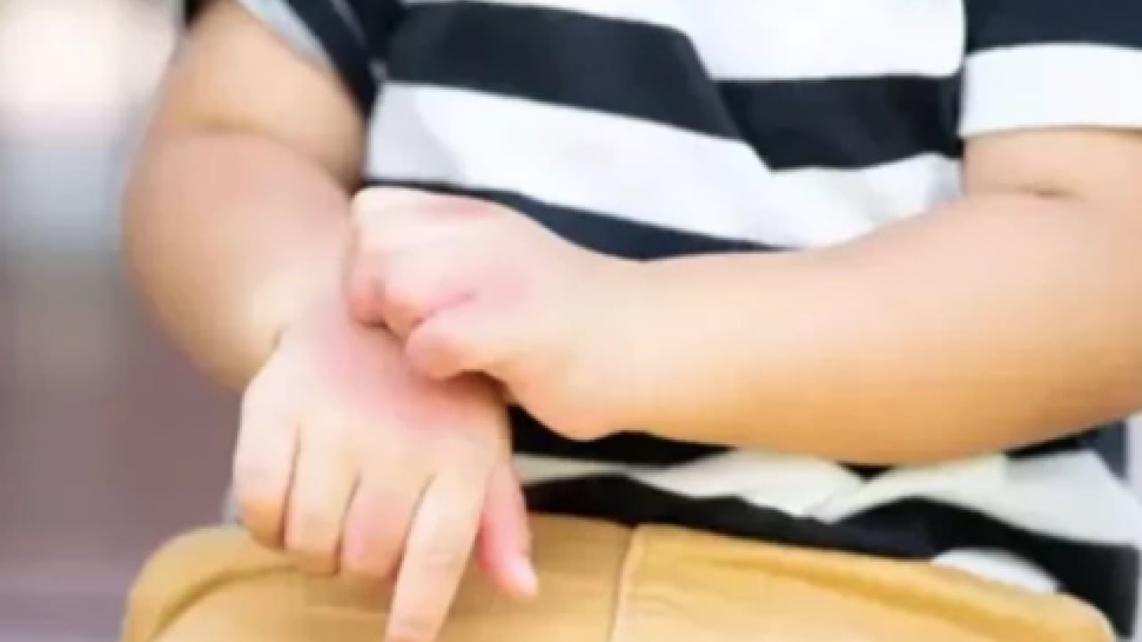 Foto - Atopik dermatit vakaları... Egzaması olan bebekler için ciddi önlem alınmalı...