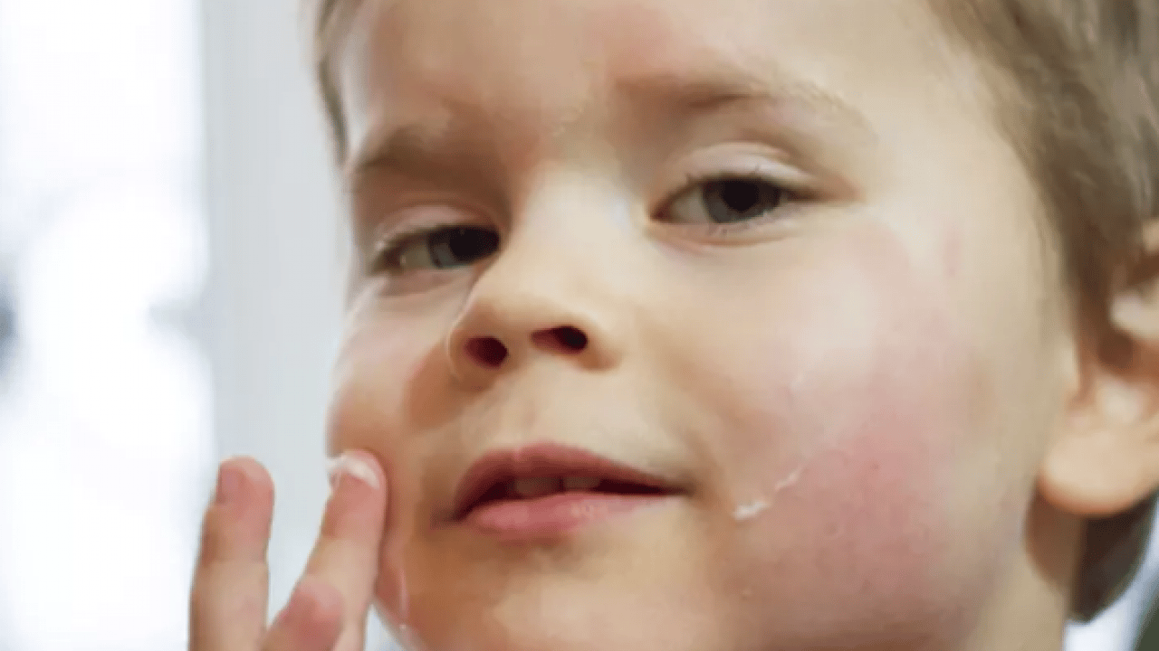 Foto - Atopik dermatit vakaları... Egzaması olan bebekler için ciddi önlem alınmalı...