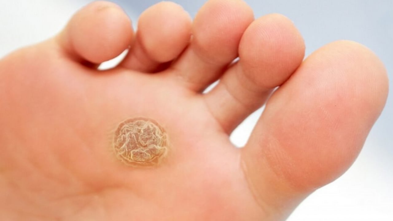 Foto - Ayak nasırlarına bitkisel çözümler: Nasırı kökünden söküp atıyor! Söküp atmanın doğal yolu