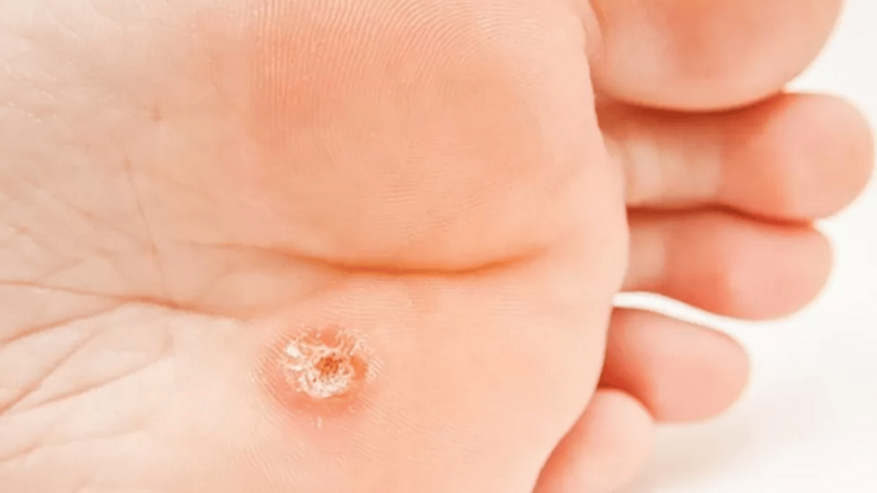 Foto - Ayak nasırlarına bitkisel çözümler: Nasırı kökünden söküp atıyor! Söküp atmanın doğal yolu