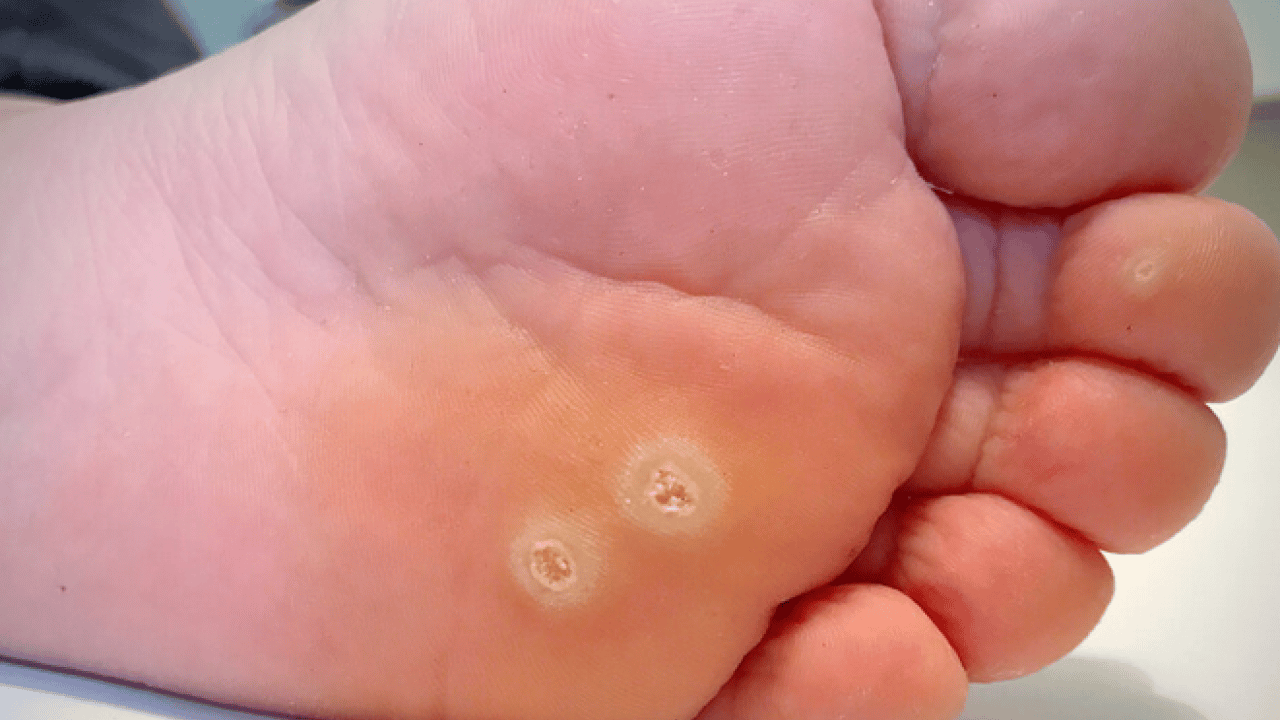 Foto - Ayak nasırlarına bitkisel çözümler: Nasırı kökünden söküp atıyor! Söküp atmanın doğal yolu