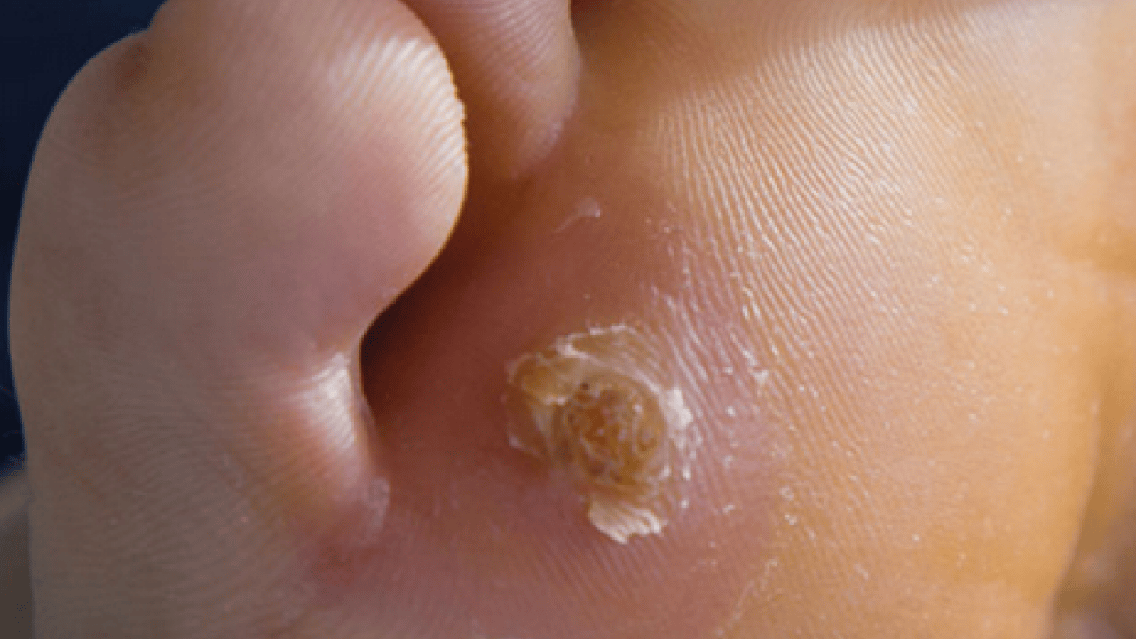 Foto - Ayak nasırlarına bitkisel çözümler: Nasırı kökünden söküp atıyor! Söküp atmanın doğal yolu