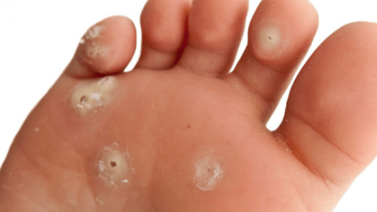 Foto - Ayak nasırlarına bitkisel çözümler: Nasırı kökünden söküp atıyor! Söküp atmanın doğal yolu